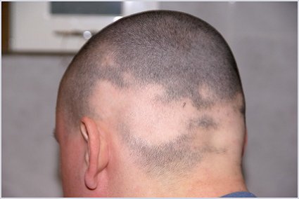 Mann mit kreisrundem Haarausfall